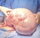 خارج‌ کردن توده ۱۰ کیلویی از شکم بیمار در کرج